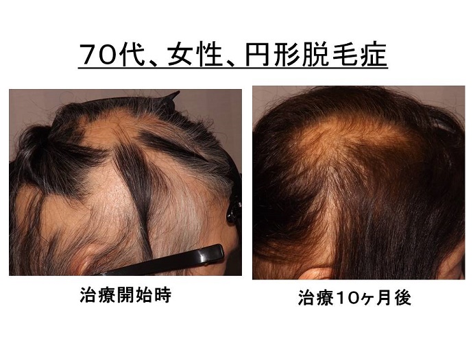 円形脱毛症　病院""
